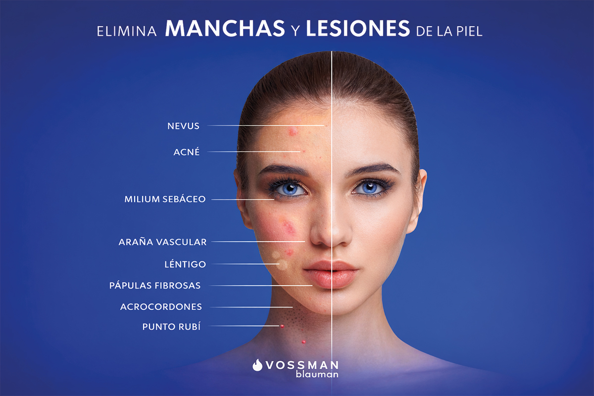 Láser azul Blauman tratamiento lesiones benignas